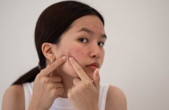 What Are the Best Skincare Products for Acne-Prone Skin?